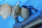 Intensiv Cons PS0/3 Proxoshape 125µm 3stk