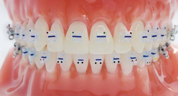 FO G950T1000 Model Glam Ceramic Brackets