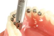 BT IX953 Lingual Cinch Bach 