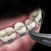 HF 678-501 Slim Line Weingart Plier