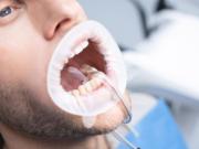 OptraGate Dry Control 60stk