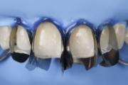 Unica Anterior 6951 Minideep matriser 50stk