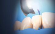 Unica Anterior 6914 Proximal matriser 50stk